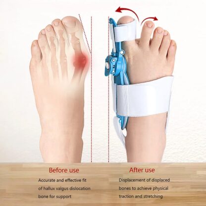 12738 Bunion Support Splint. Valgus And Bunion Valgus, Corrector, Hallux Valgus Corrector, Adjustable Bunion Valgus Protective Cover For Men And Women - Image 5